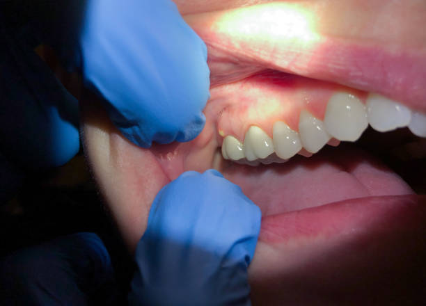 Best Emergency Treatment for Dental Infections or Abscesses in Forest, MS